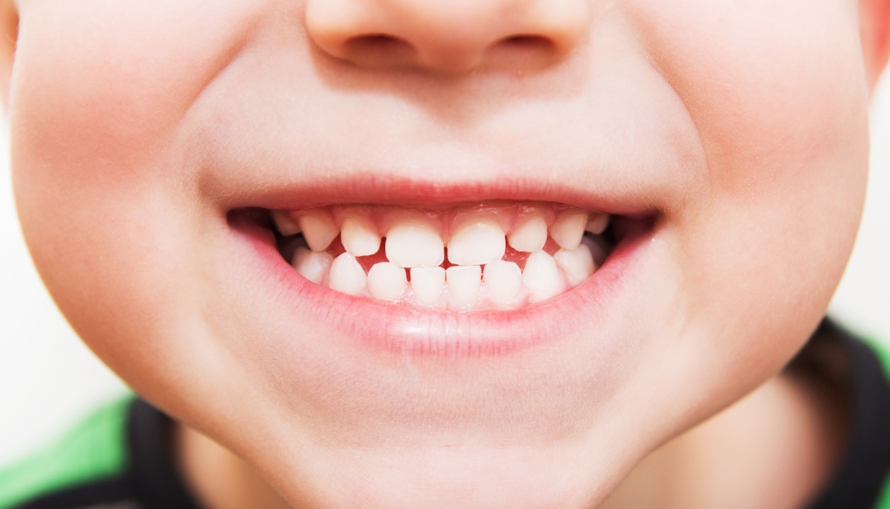 Close-up of a smiling boy showcasing a healthy smile, emphasizing the benefits of early orthodontic care.