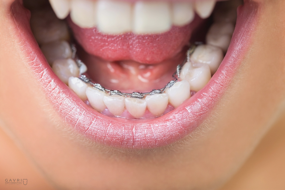 Close-up photo of lingual braces, as one of alternatives to braces in Richmond, TX 