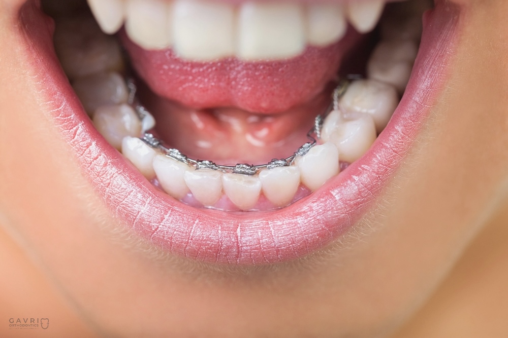 Close-up of lingual braces placed behind the teeth for discreet orthodontic treatment.